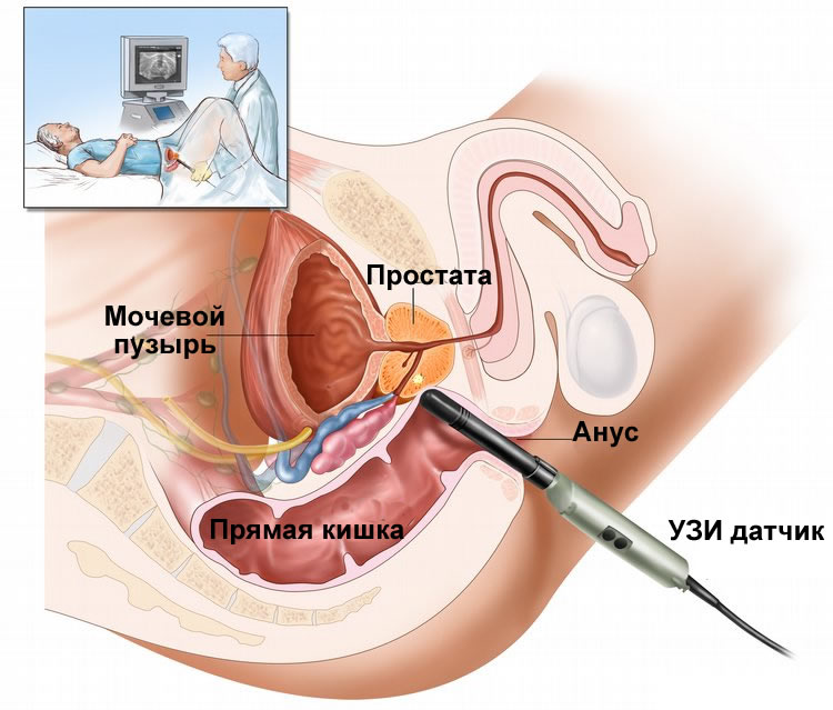 Как делается узи предстательной железы
