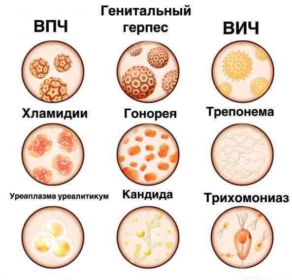 Какие есть половые инфекции
