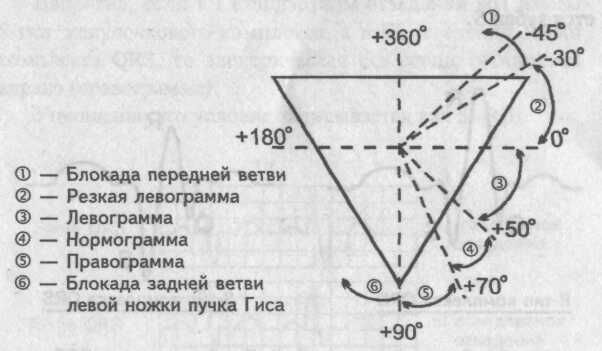 Левограмма на экг что это