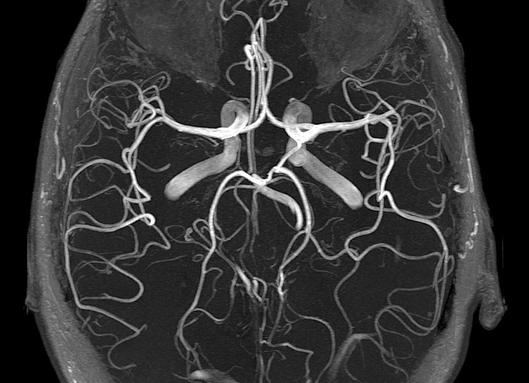 Мрт сосудов головного мозга