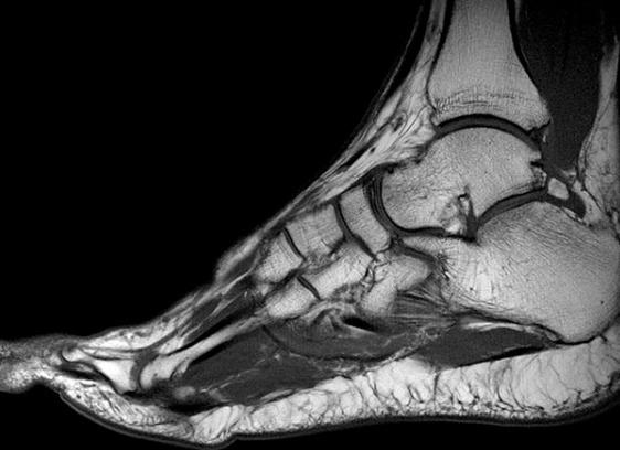 Мрт голеностопного сустава