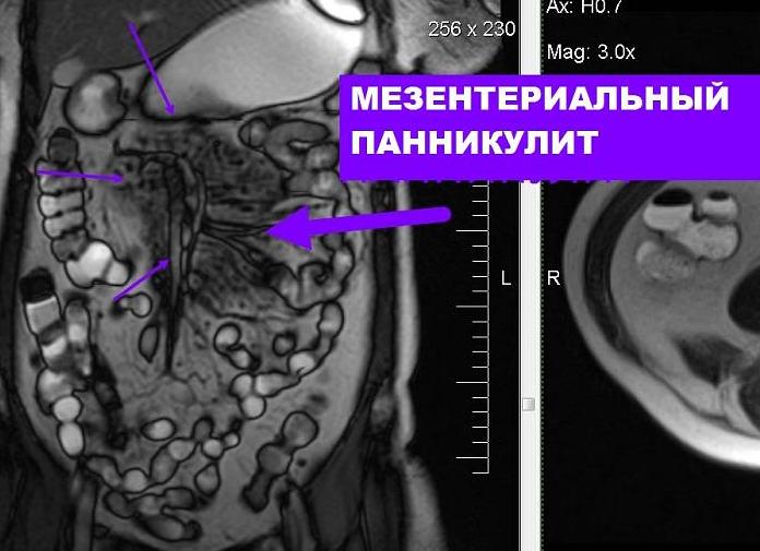 Мрт энтерография тонкого кишечника