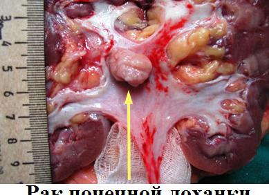 Макрогематурия у женщин что это такое