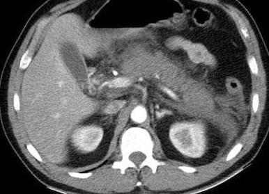 Кт поджелудочной железы Кт поджелудочной железы