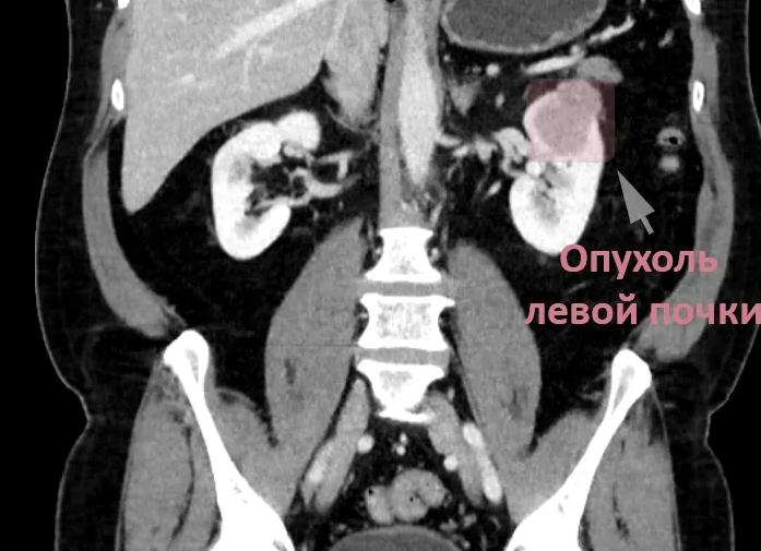 Кт почек и мочевыводящих путей