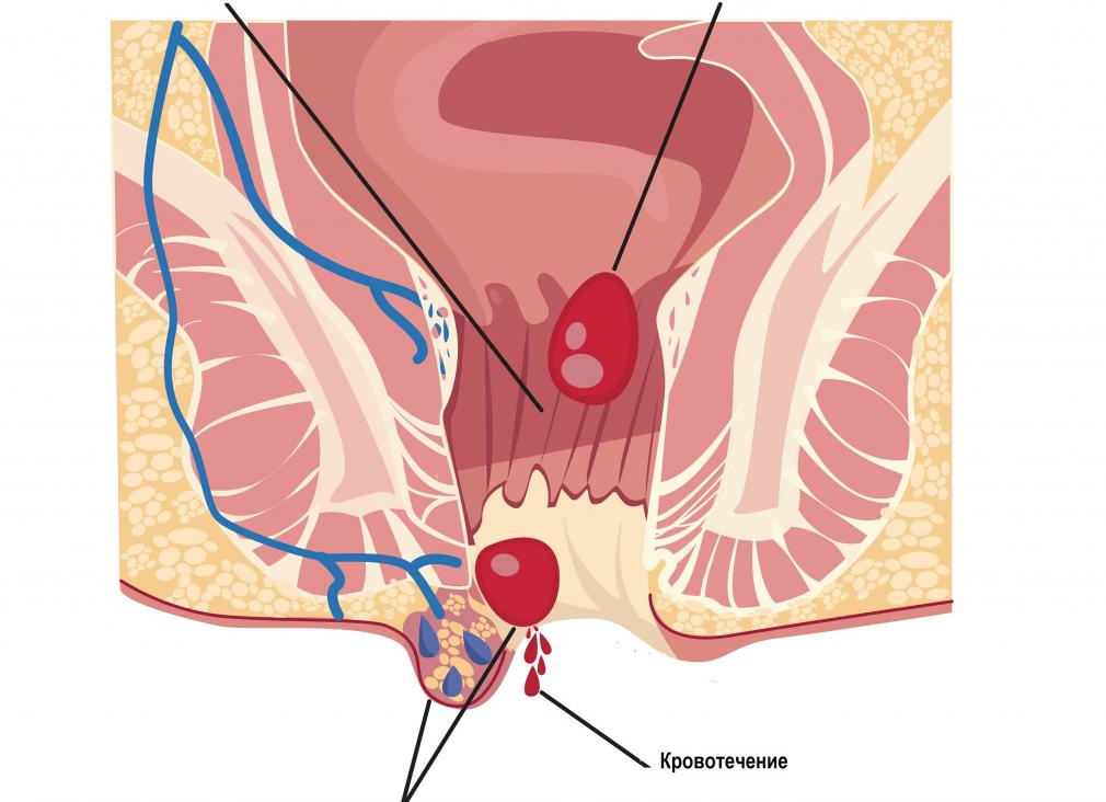Кал с кровью причина у взрослого