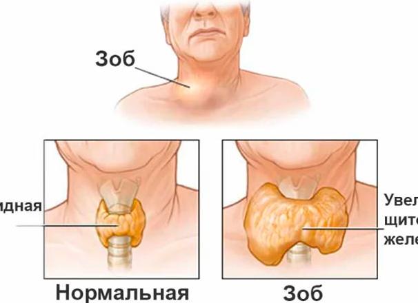 Как определить увеличена ли щитовидная железа