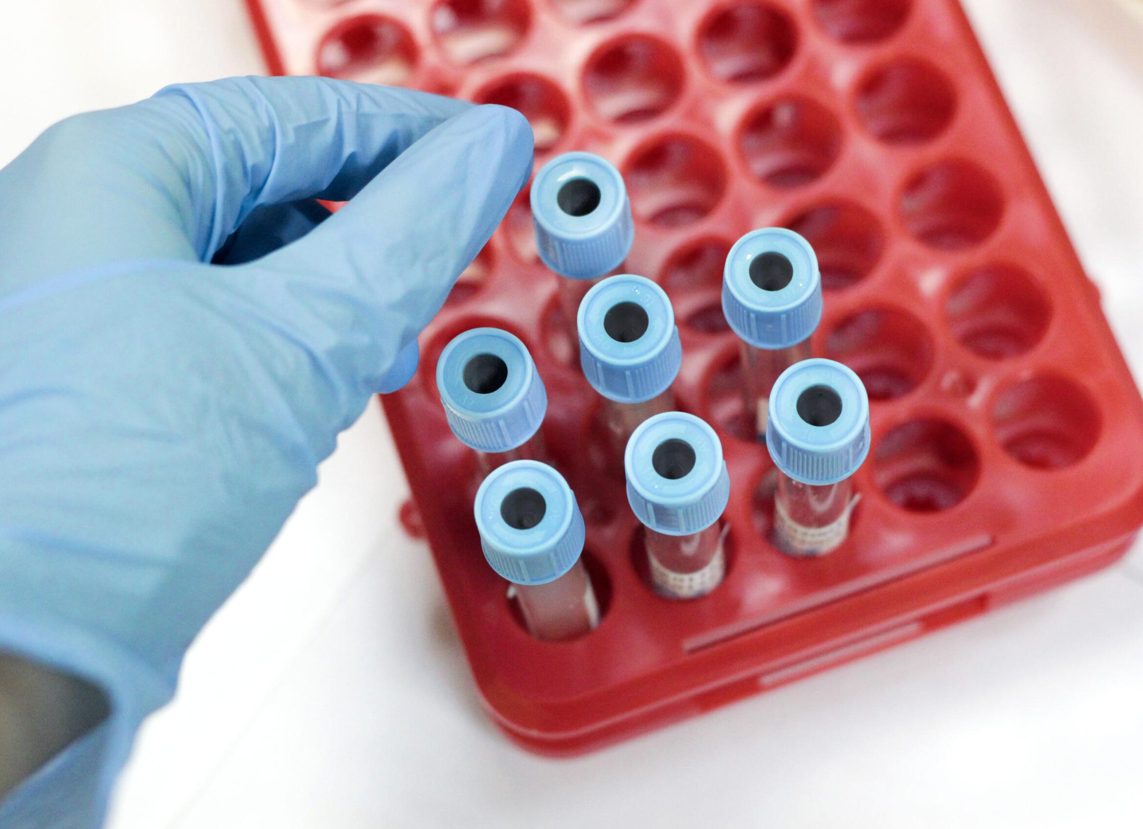 Как алкоголь влияет на анализ крови и мочи