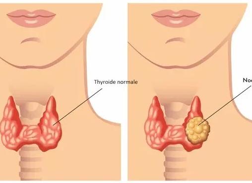 Гипоэхогенный узел щитовидной железы что это такое