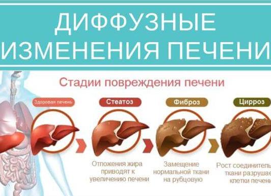 Дифузные изменениә печени