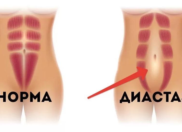 Диастаза что это