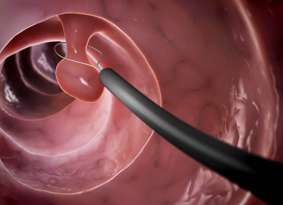 Что такое полип