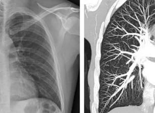 Чем отличается кт от рентгена