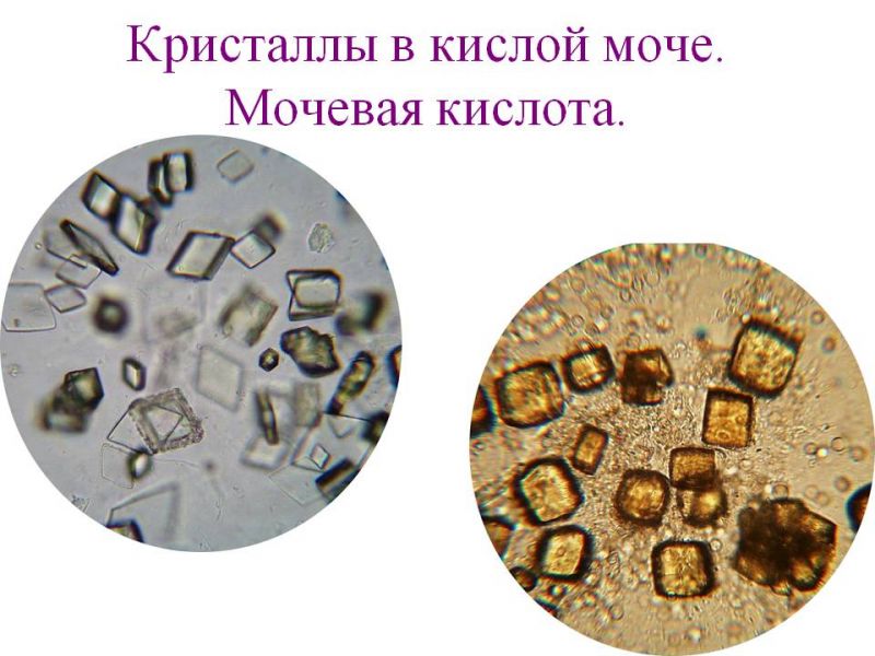 Какие бывают соли в моче