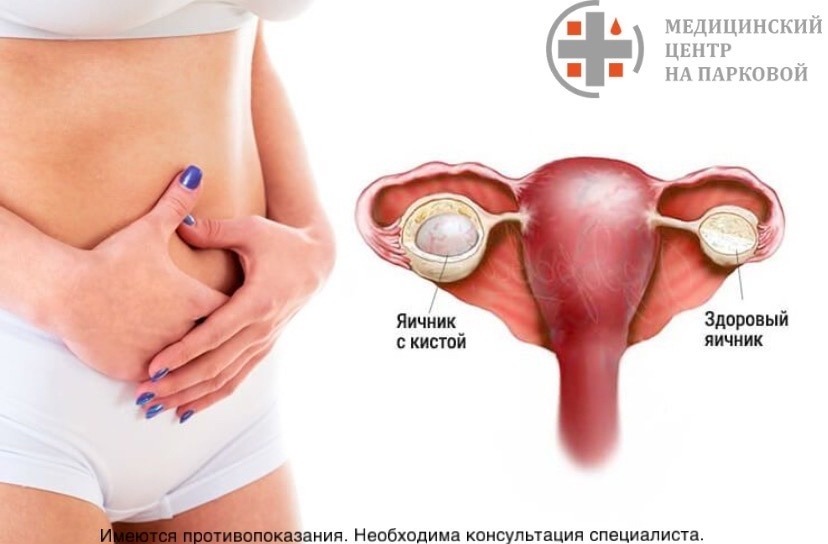 Киста у девушек