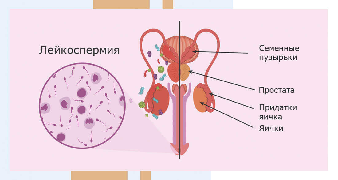 Кровь в спермограмме