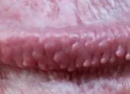 Молочница у парней