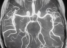 Магнитно резонансная ангиография сосудов головного мозга