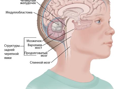 Киста в голове у взрослого последствия Киста в голове у взрослого последствия