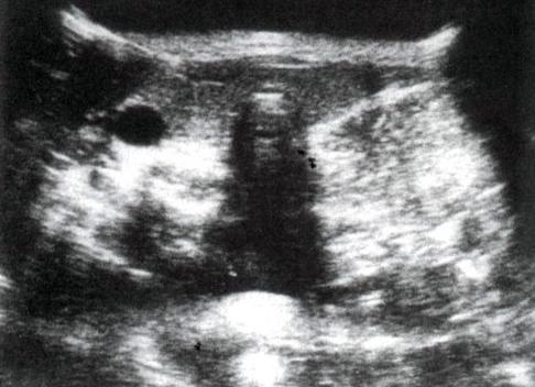 Как выглядит липома на узи