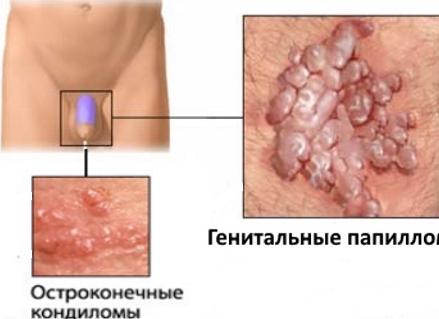 Как впч проявляется у мужчин