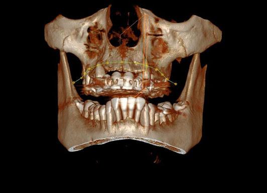 Как часто можно делать кт зубов