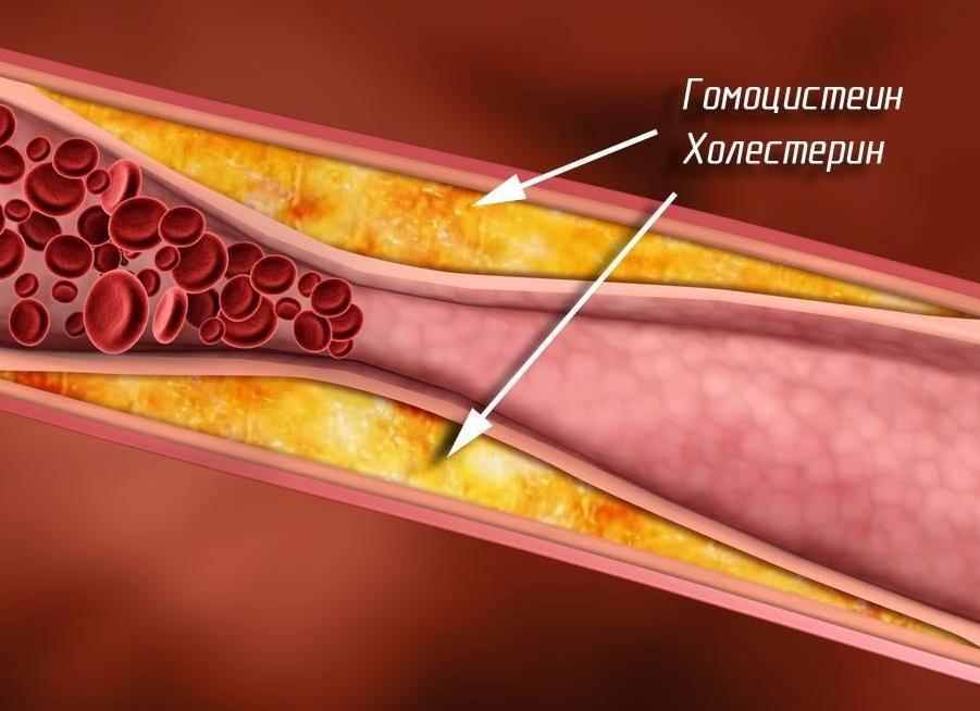Гомоцистеин анализ крови для чего Гомоцистеин анализ крови для чего