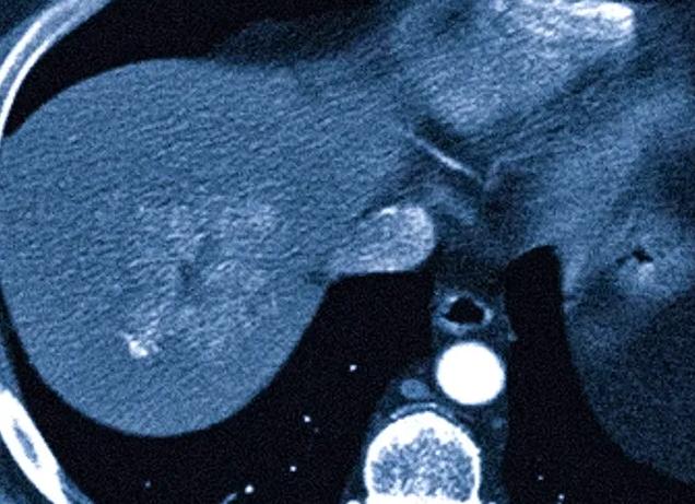 Гиподенсное округлое образование