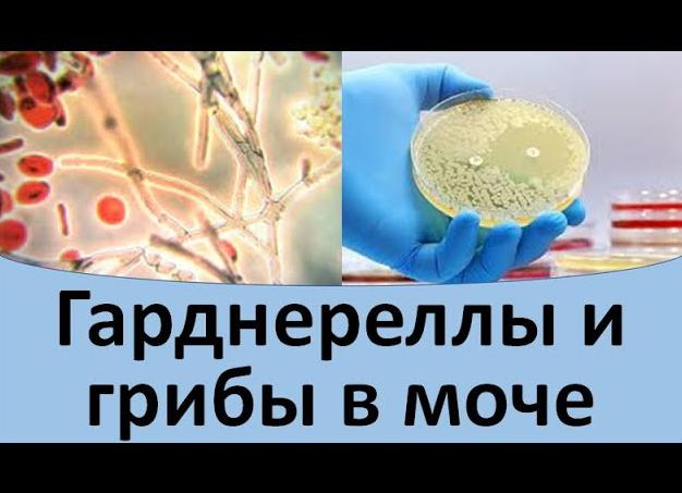 Гарднерелла в моче