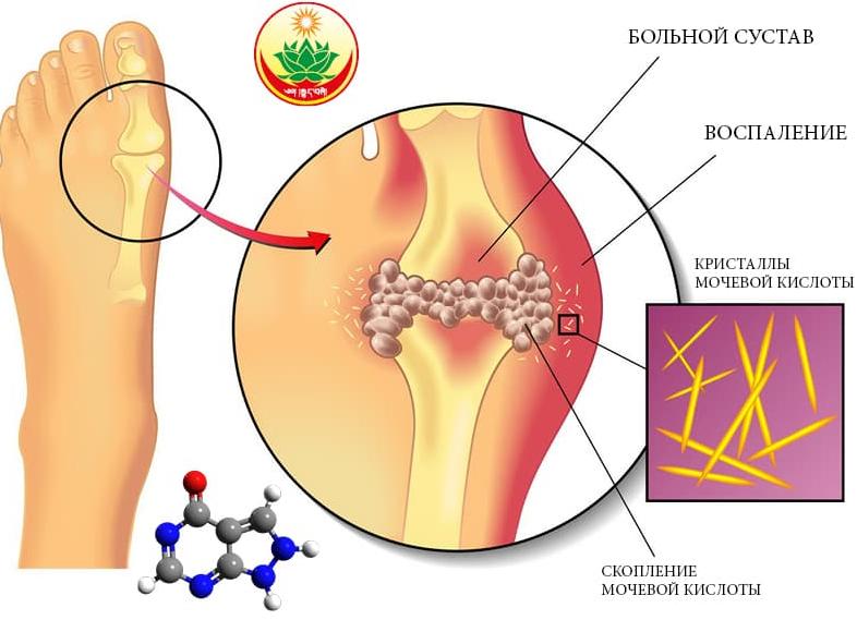 Если повышена мочевая кислота в крови что это значит
