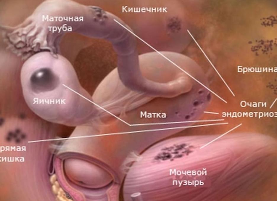 Эндометриоз 2 степени насколько это серьезно можно ли вылечить