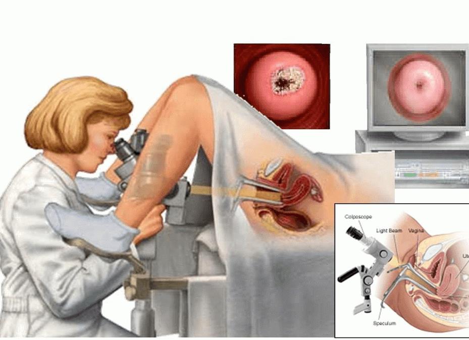 Что взять с собой на кольпоскопию