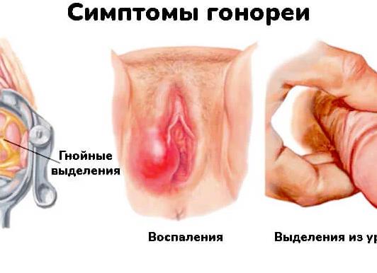 Что такое гонорея фото у мужчин Что такое гонорея фото у мужчин