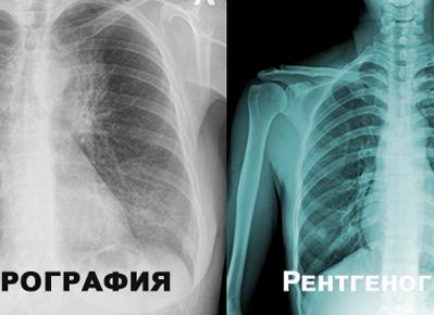 Чем отличается рентгенография от флюорографии Чем отличается рентгенография от флюорографии
