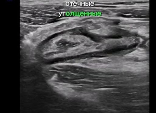 Аппендицит на узи