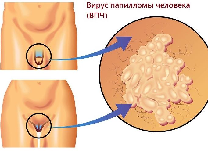 Анализ впч что это такое у женщин