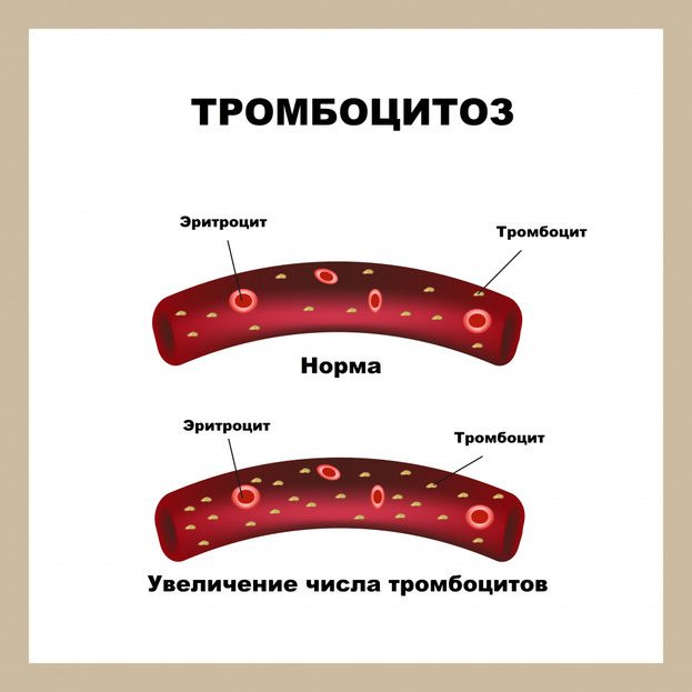 Как выглядят тромбоциты