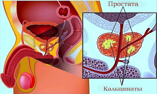 Кальцинаты это что