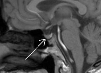 Мрт турецкое седло головного мозга