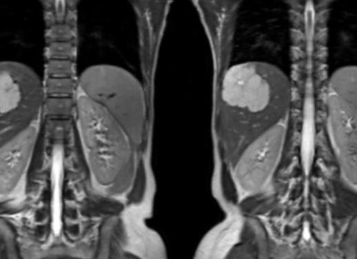 Мрт почек что показывает