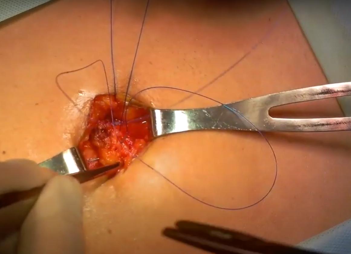 Можно ли увидеть пупочную грыжу на узи Можно ли увидеть пупочную грыжу на узи