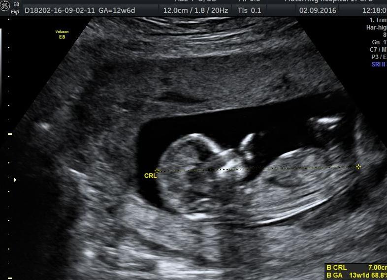 Ктр что это узи Ктр что это узи