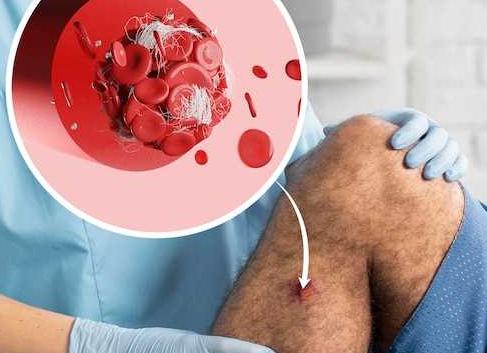 Кровь на эдс