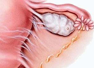 Косвенные признаки спаечного процесса в малом тазу что это