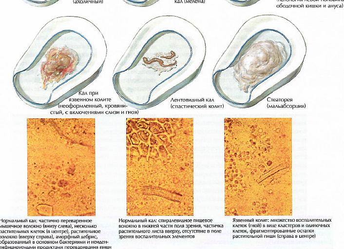 Кал разного цвета при дефекации у взрослого