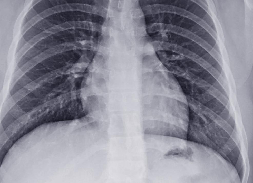 Как часто можно делать флюорографию легких взрослым