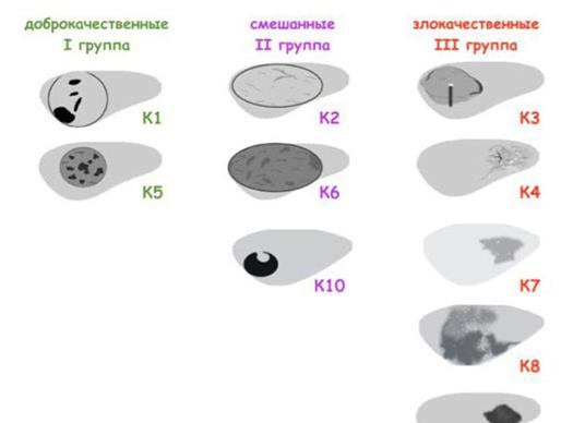 Изоэхогенный узел щитовидной железы что это