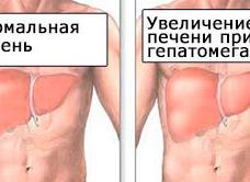 Что такое гепатомегалия