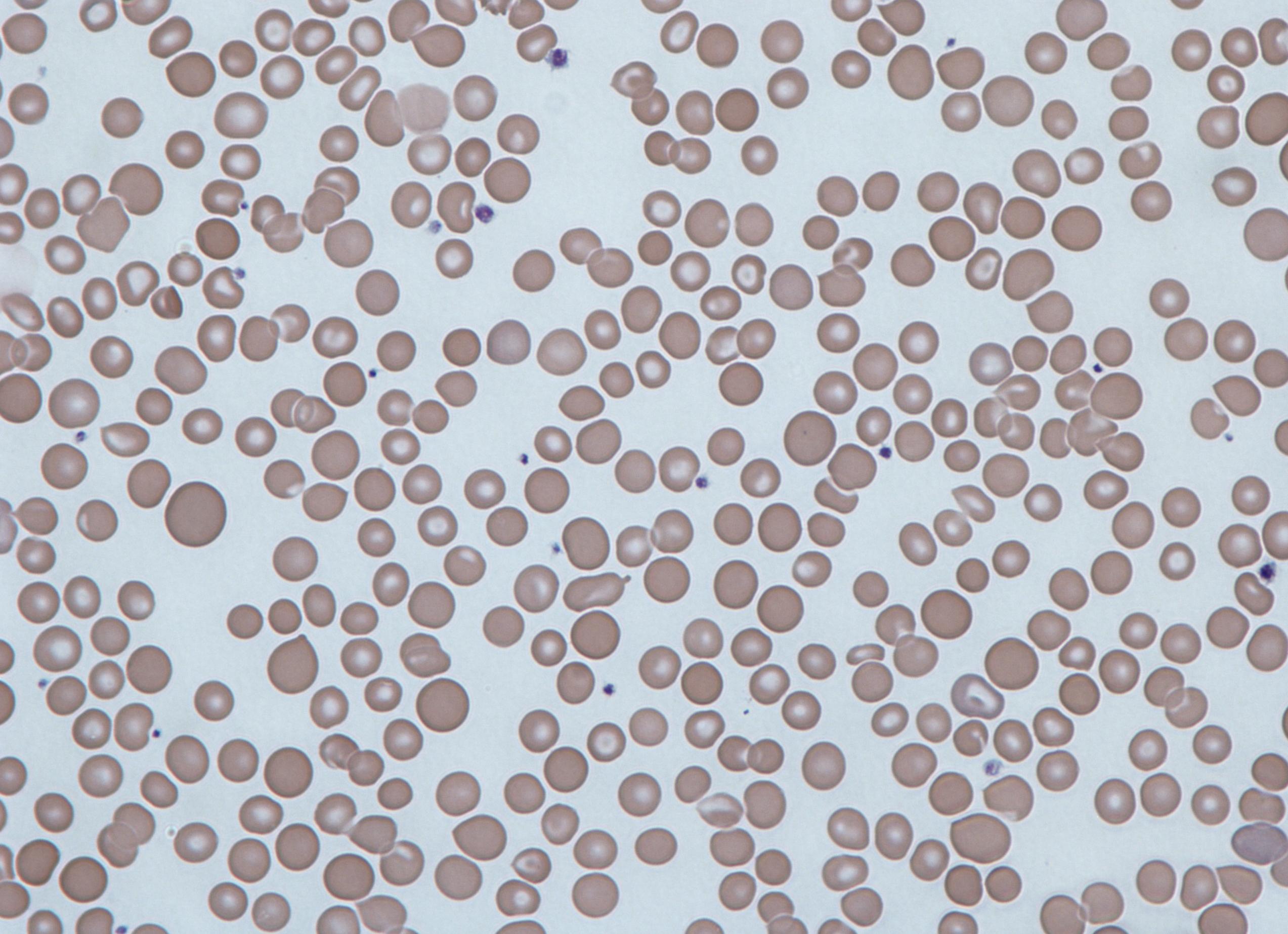 Анизоцитоз в крови