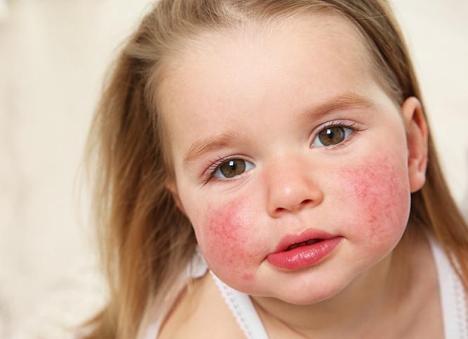 Аллергия на яичный белок Аллергия на яичный белок